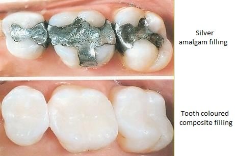 Do Dental Crowns Contain Mercury?