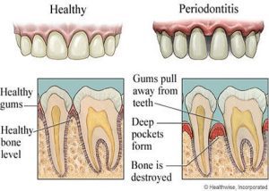 Periodontal Treatment with Ozone San Diego