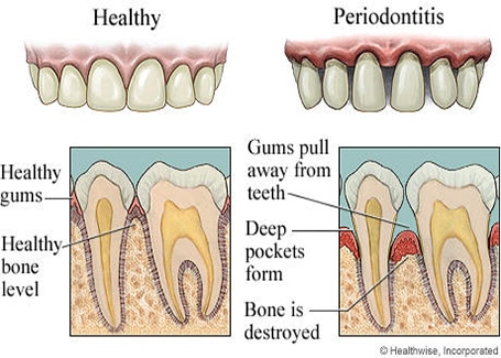 Periodontal Treatment Ozone San Diego - Dr. George C. Georgaklis, DDS