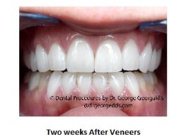 Teeth with porcelain veneers