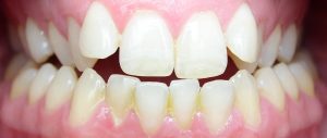 straight teeth in one week san diego