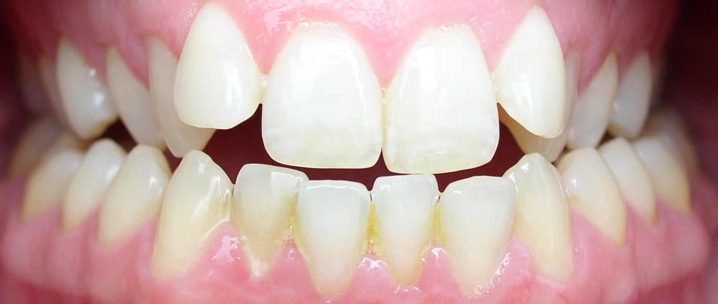 How Fast Can My Teeth Be Straightened?  La Jolla Cosmetic Dentistry &  Orthodontics