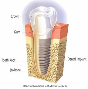 dental-implants-san-diego