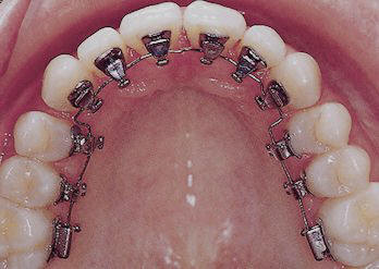 What are Invisible Lingual Braces?