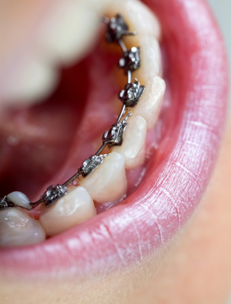 The Pros and Cons of Braces Behind Teeth