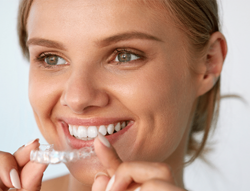 How To Get Straight Teeth in Six Months with Fast Braces in San Diego