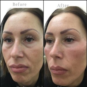 Dermal Fillers before and after