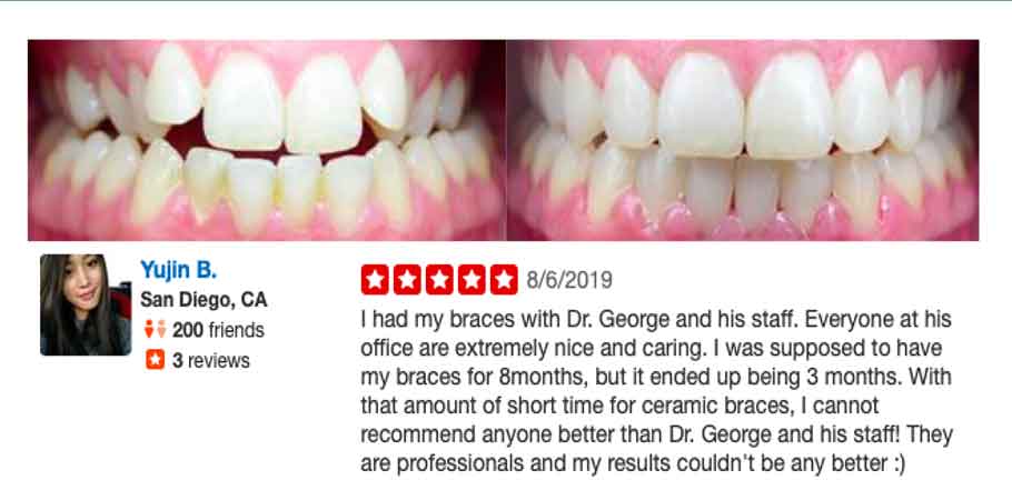 6 month braces sd testimonial