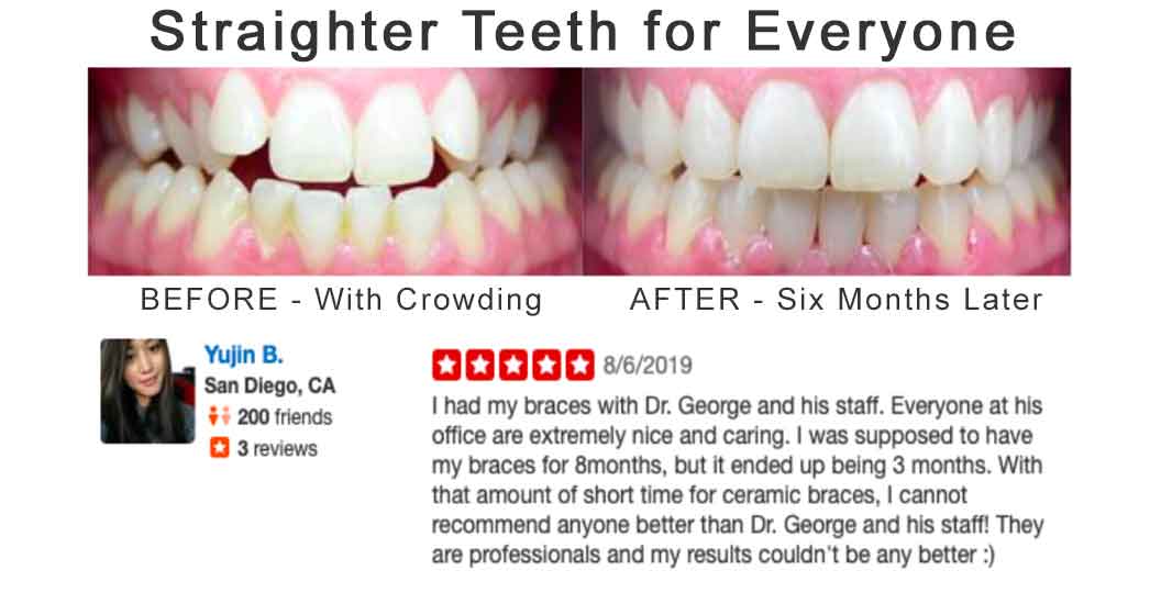 Satisffied Customer Braces Review with Before After