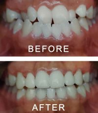 Straight Teeth in Six Months with Dr George Georgaklis