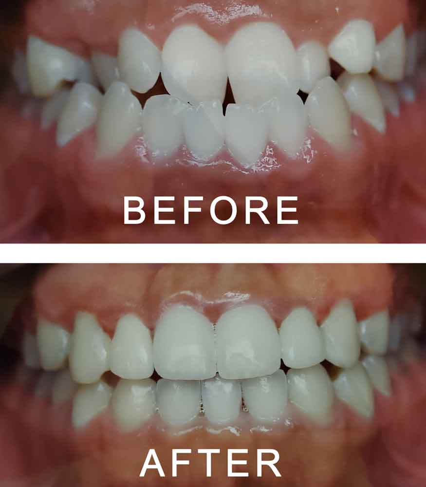 Straight Teeth in Six Months with Dr George Georgaklis