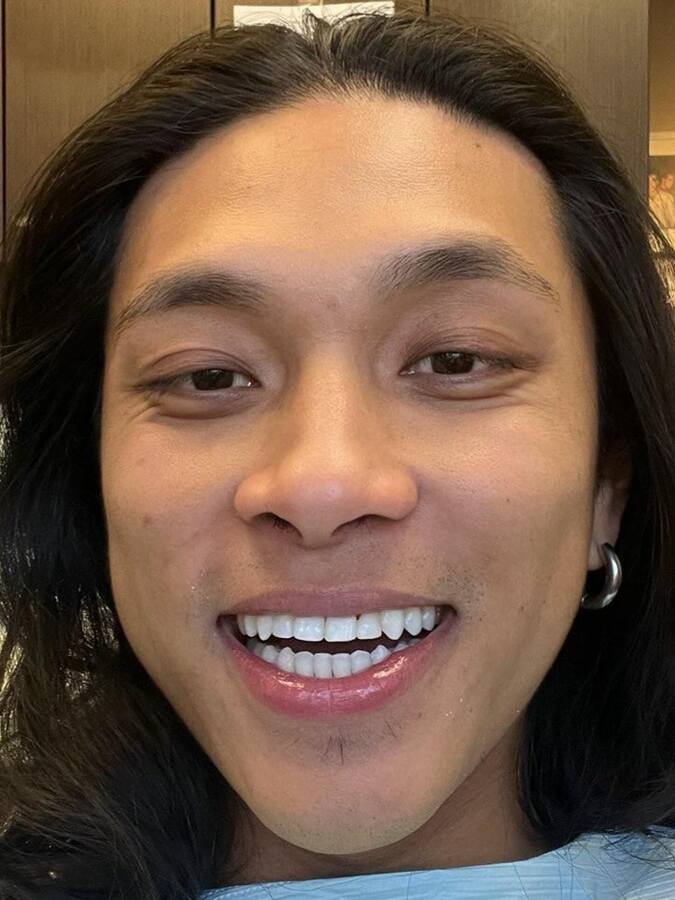 Dr Georgaklis provided Orthodontics for one month to make the space equal for two veneers using a custom shade on the lateral incisors