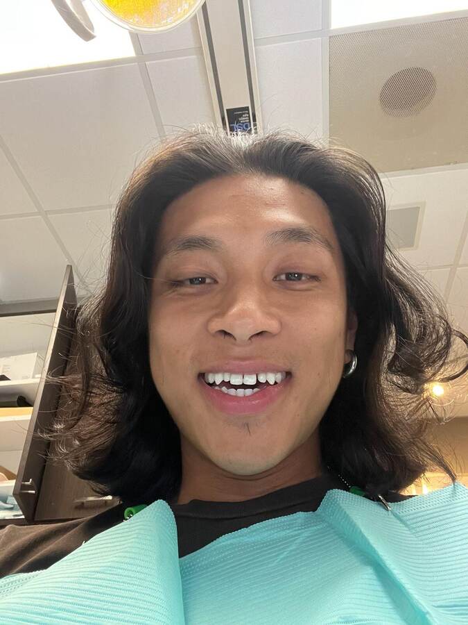 Dr Georgaklis provided Orthodontics for one month to make the space equal for two veneers using a custom shade on the lateral incisors