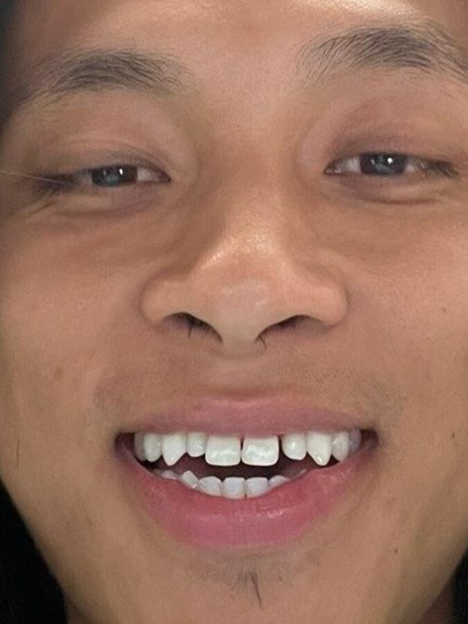 Dr Georgaklis provided Orthodontics for one month to make the space equal for two veneers using a custom shade on the lateral incisors