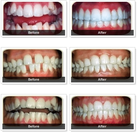StraightTeethIn6MonthsBeforeAfter