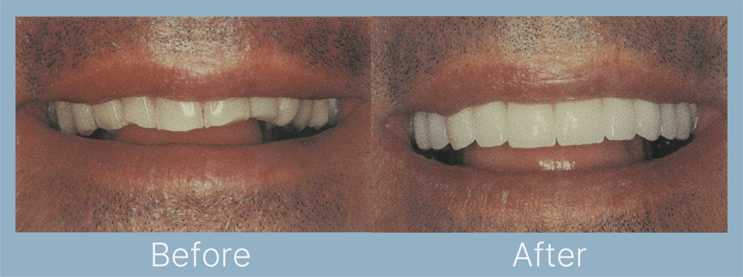 Veeners Before After 3